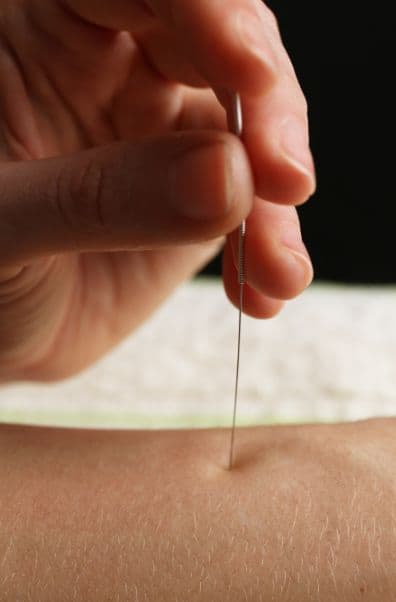 Acupuncture in East Toronto: What to Expect During Your First Visit