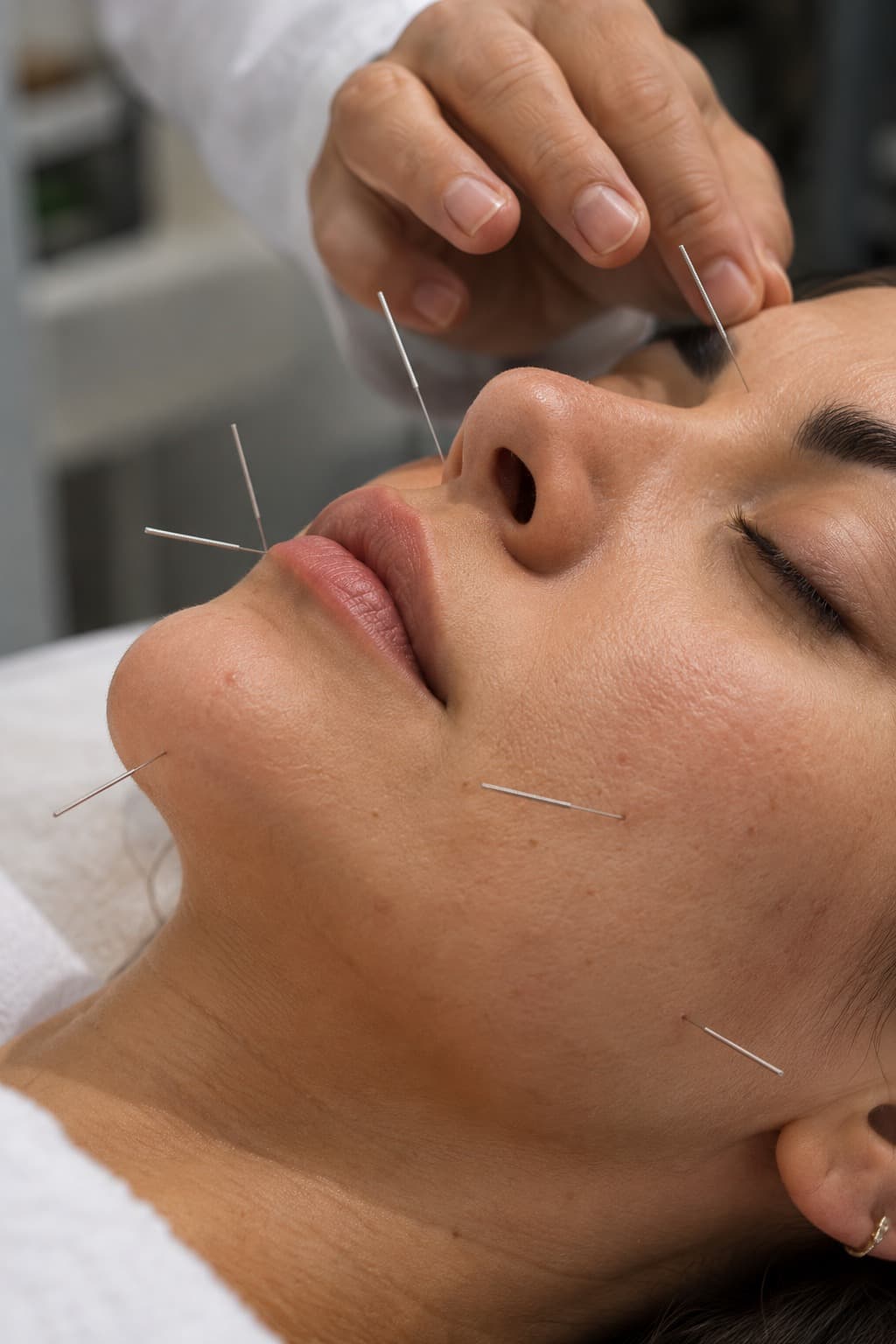 Cosmetic Acupuncture